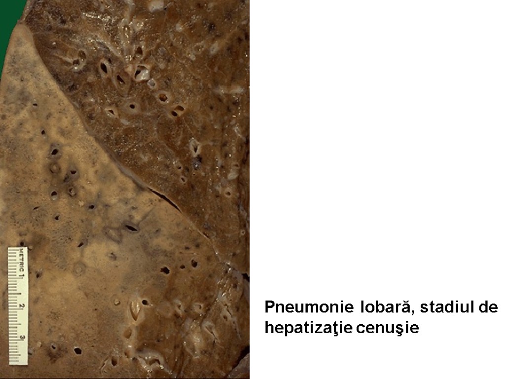 Pneumonie lobară, stadiul de hepatizaţie cenuşie